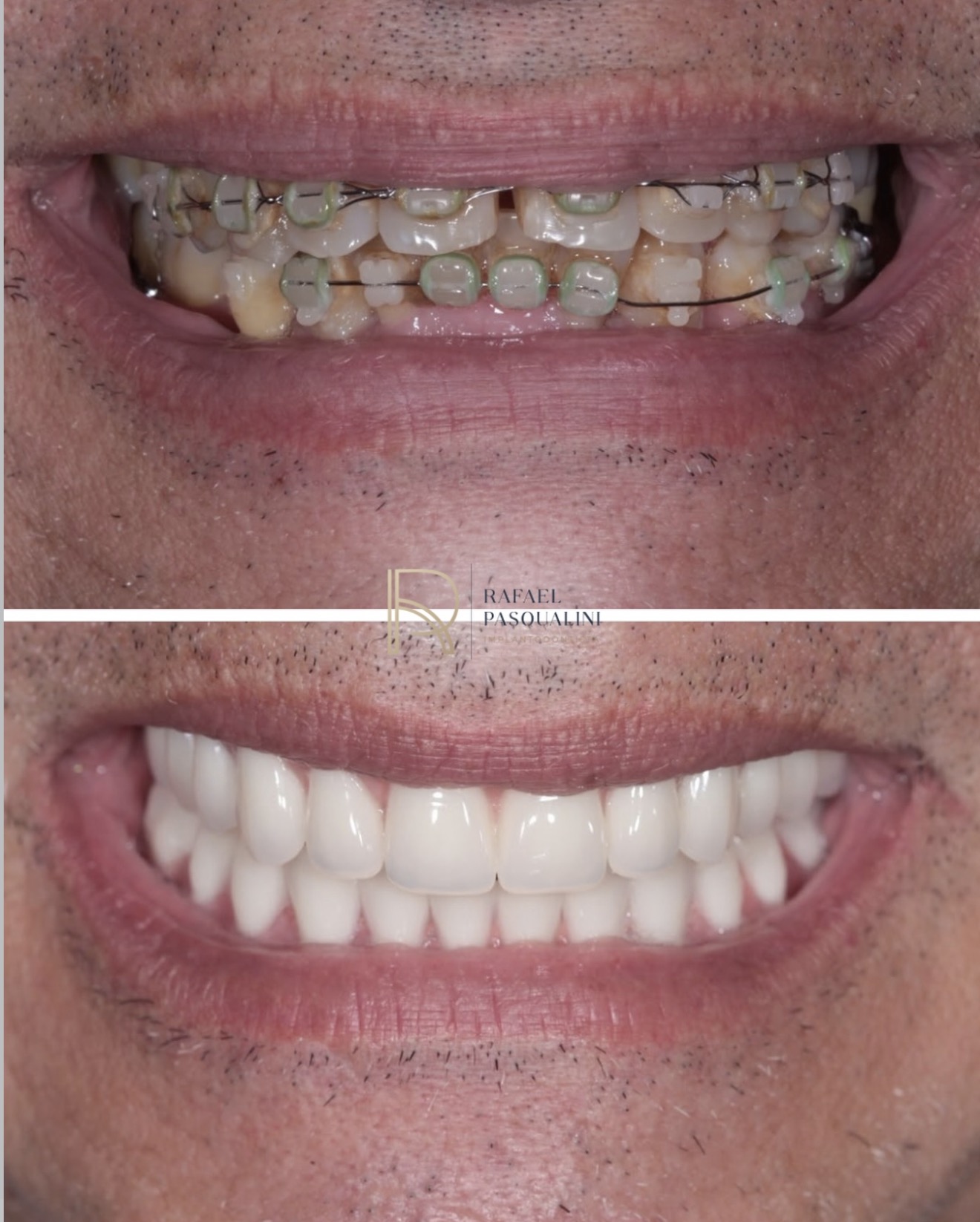 Protocolo com carga imediata — antes e depois